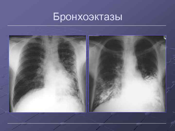 Бронхоэктазы 