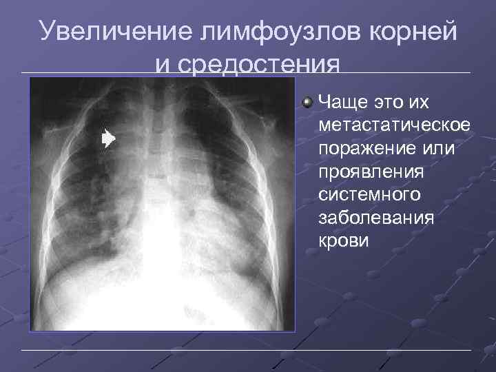 Увеличение лимфоузлов корней и средостения Чаще это их метастатическое поражение или проявления системного заболевания