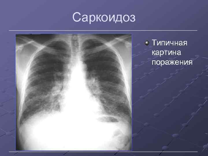 Саркоидоз. Саркоидоз рентгенологическая картина. Снимки легких при саркоидозе.