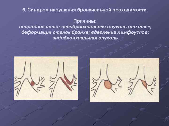 5. Синдром нарушения бронхиальной проходимости. Причины: инородное тело; перибронхиальная опухоль или отек, деформация стенок
