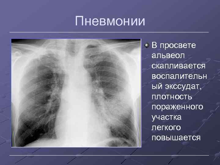 Пневмонии В просвете альвеол скапливается воспалительн ый экссудат, плотность пораженного участка легкого повышается 