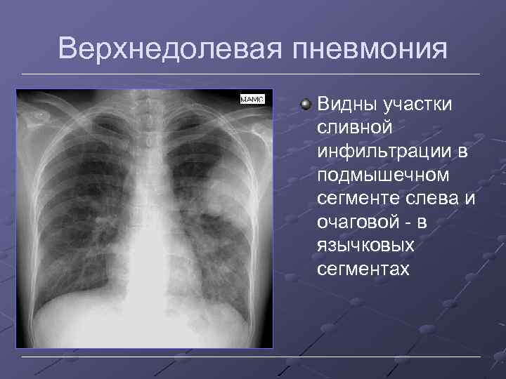 Вирусная пневмония видна на рентгене. Левая верхнедолевая пневмония на рентгене. Рентген верхнедолевой правосторонней пневмонии. Очаговая верхнедолевая пневмония рентген. Верхнедолевая пневмония справа рентген.