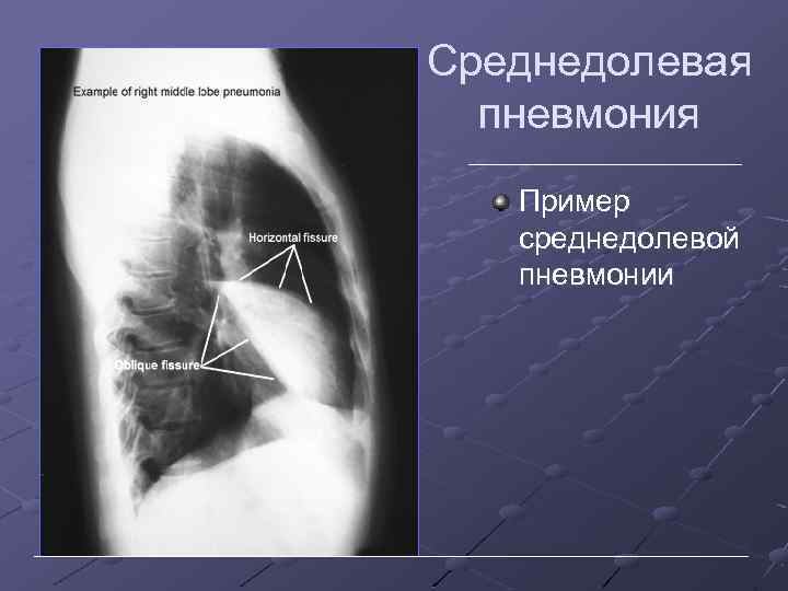 Среднедолевая пневмония Пример среднедолевой пневмонии 