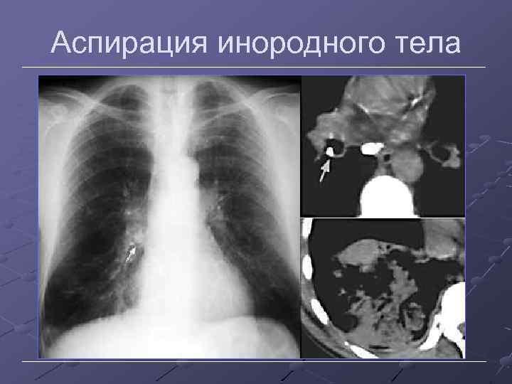 Аспирация инородного тела 