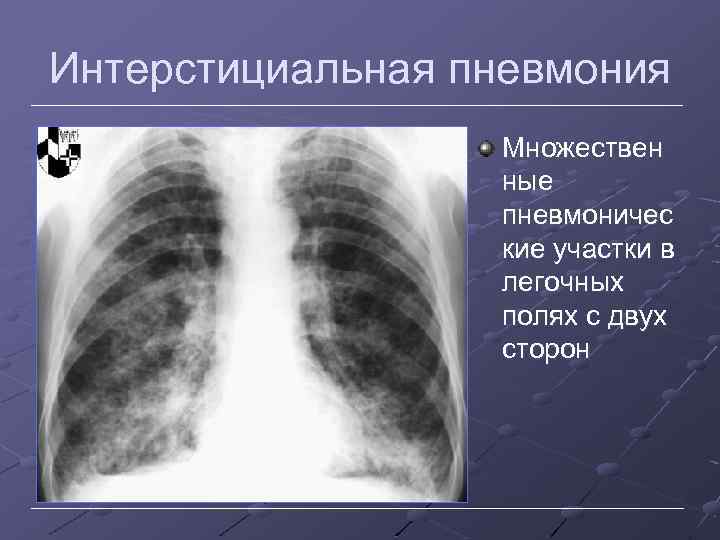 Интерстициальная пневмония Множествен ные пневмоничес кие участки в легочных полях с двух сторон 