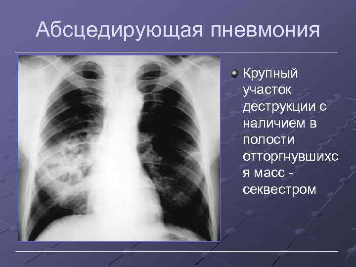 Абсцедирующая пневмония Крупный участок деструкции с наличием в полости отторгнувшихс я масс секвестром 