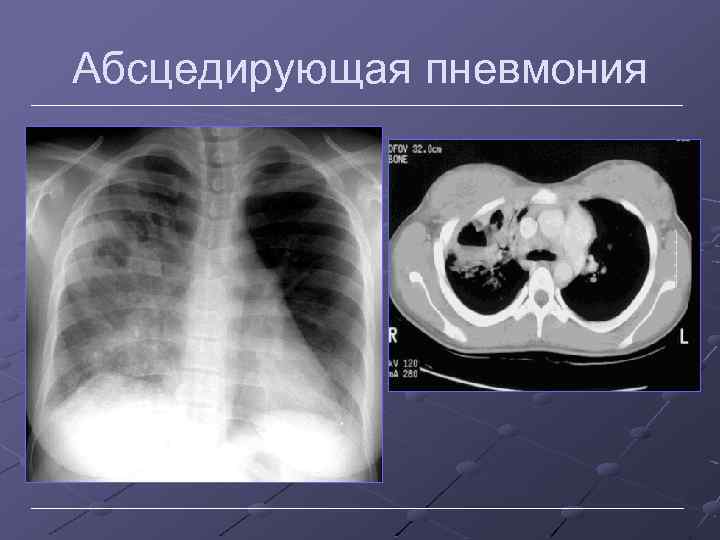 Абсцедирующая пневмония 