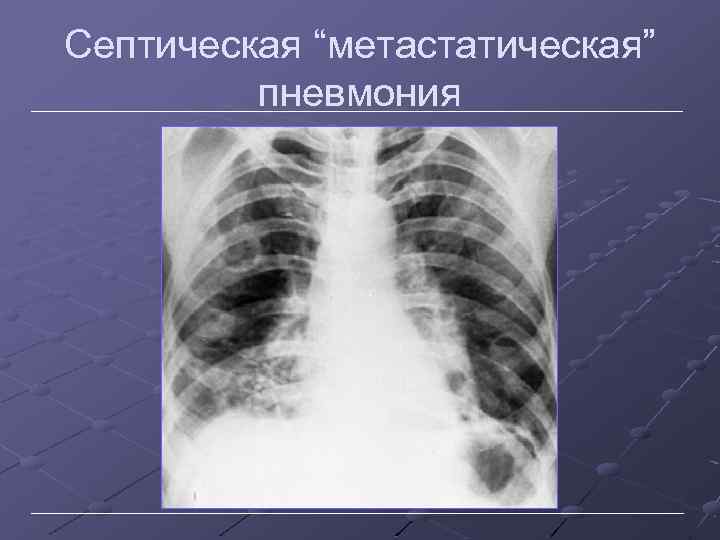 Септическая “метастатическая” пневмония 