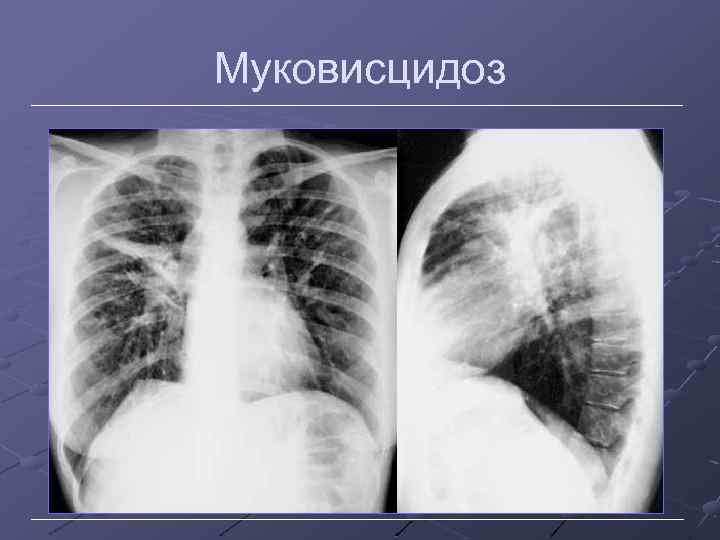 Муковисцидоз 