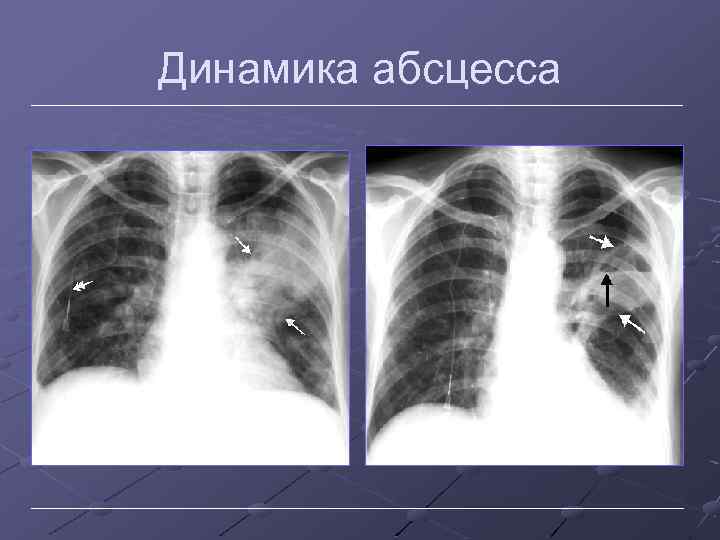 Динамика абсцесса 