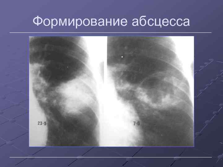 Формирование абсцесса 