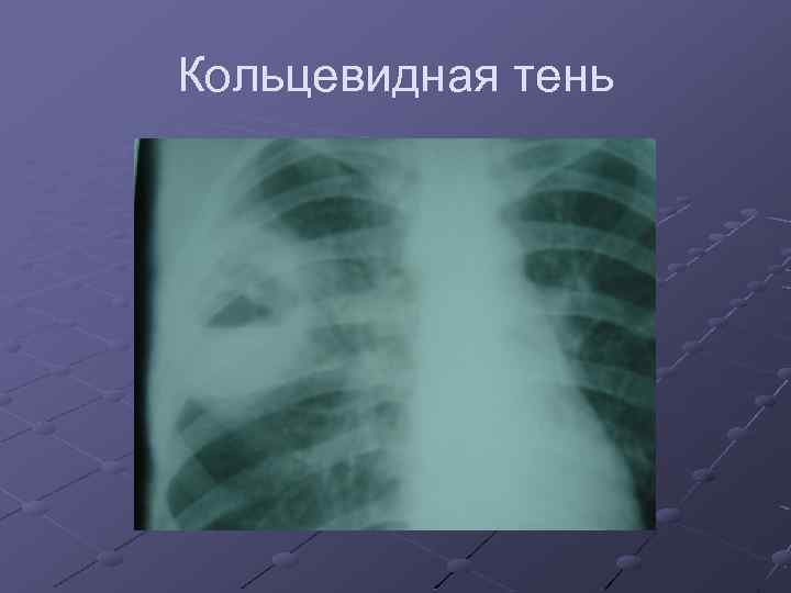 Кольцевидная тень 