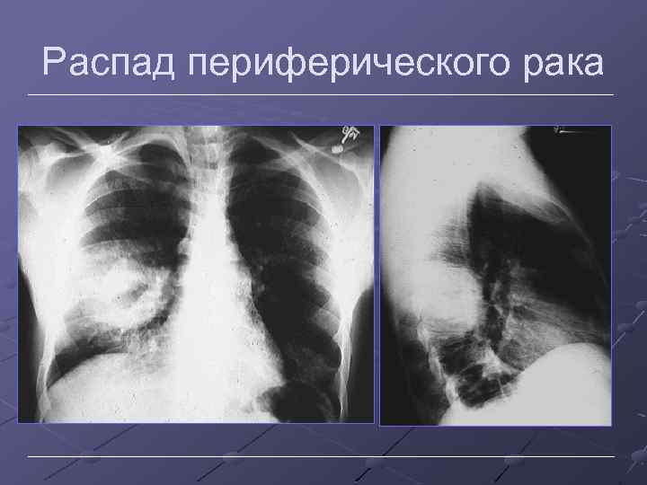 Распад периферического рака 