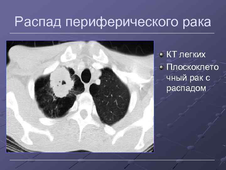 Распад периферического рака КТ легких Плоскоклето чный рак с распадом 