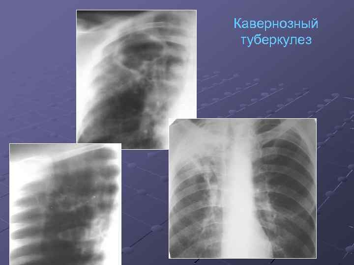 Кавернозный туберкулез 