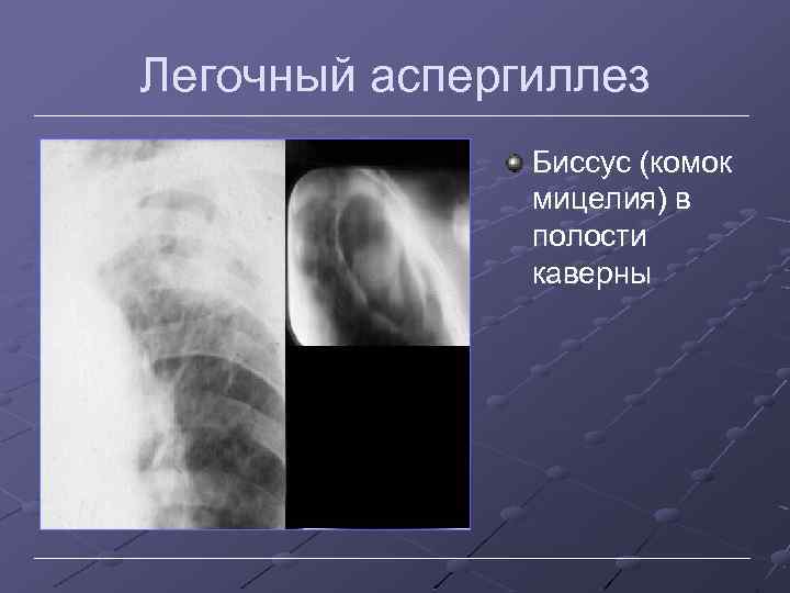 Легочный аспергиллез Биссус (комок мицелия) в полости каверны 