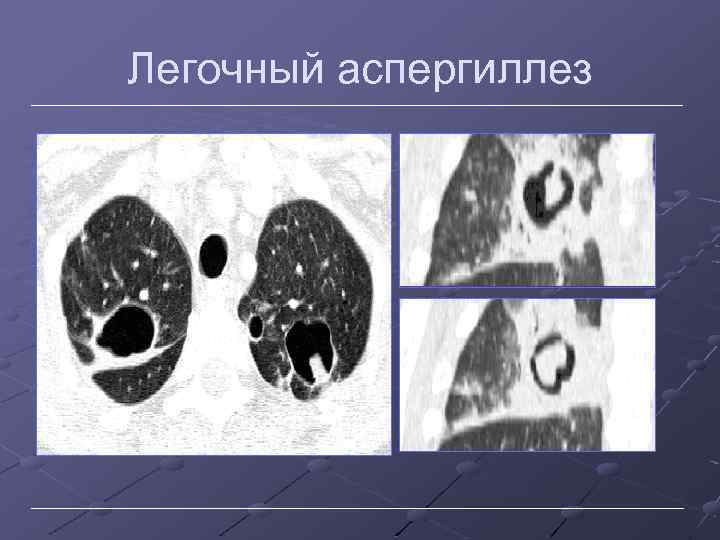 Легочный аспергиллез 