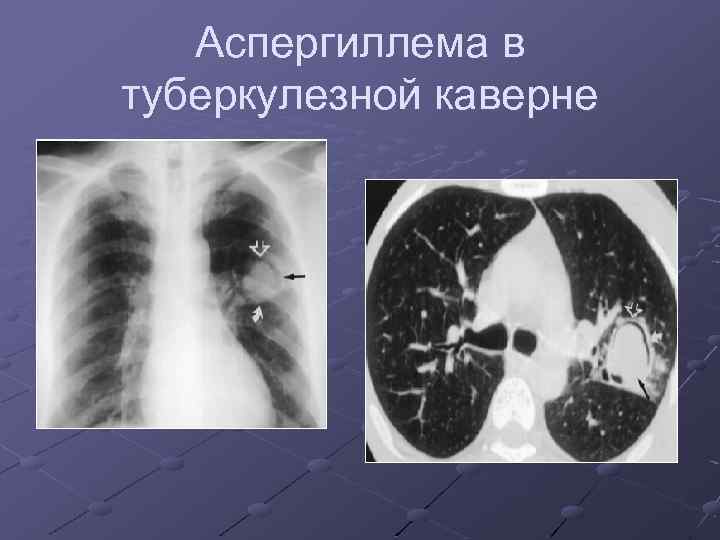 Аспергиллема в туберкулезной каверне 