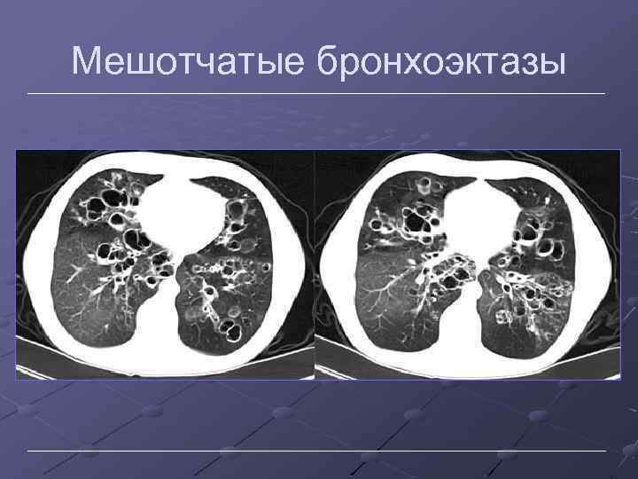 Мешотчатые бронхоэктазы 