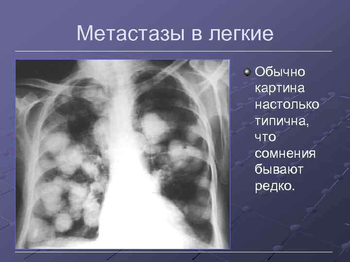 Метастазы в легкие Обычно картина настолько типична, что сомнения бывают редко. 