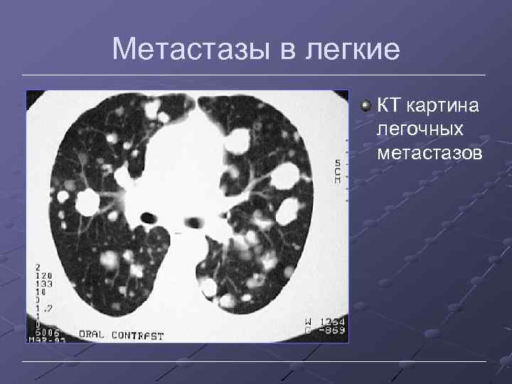 Метастазы в легкие КТ картина легочных метастазов 