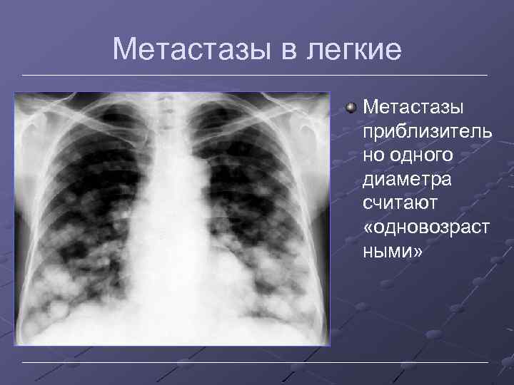 Метастазы в легкие Метастазы приблизитель но одного диаметра считают «одновозраст ными» 