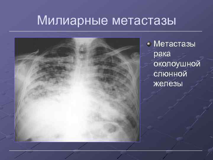 Милиарные метастазы Метастазы рака околоушной слюнной железы 