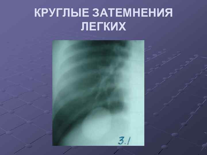 КРУГЛЫЕ ЗАТЕМНЕНИЯ ЛЕГКИХ 