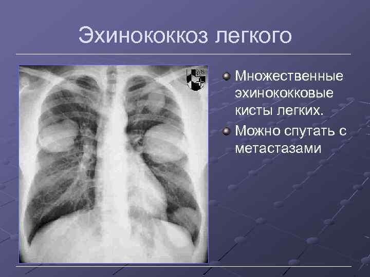 Эхинококкоз легкого Множественные эхинококковые кисты легких. Можно спутать с метастазами 