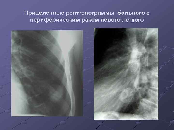 Прицеленные рентгенограммы больного с периферическим раком левого легкого 