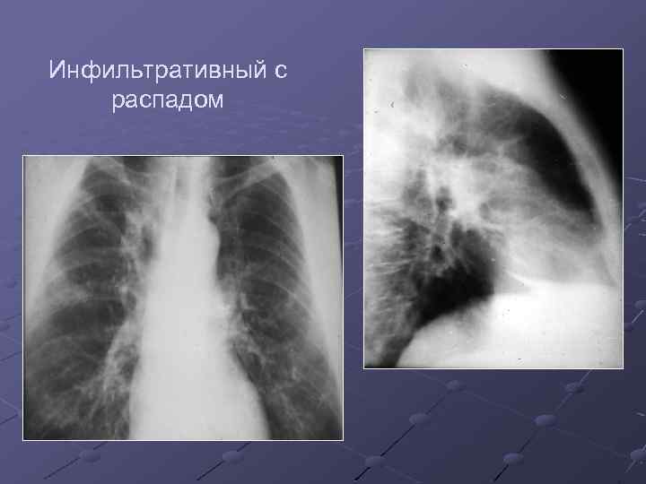 Инфильтративный с распадом 