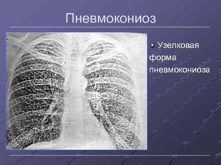 Пневмокониоз Узелковая форма пневмокониоза 