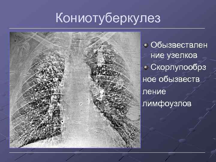 Кониотуберкулез Обызвествлен ние узелков Скорлупообрз ное обызвеств ление лимфоузлов 