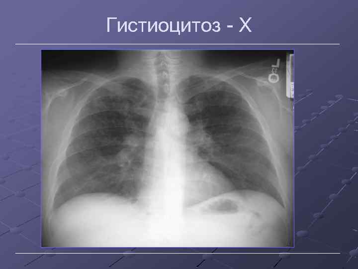 Гистиоцитоз Х 