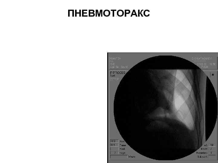 ПНЕВМОТОРАКС 