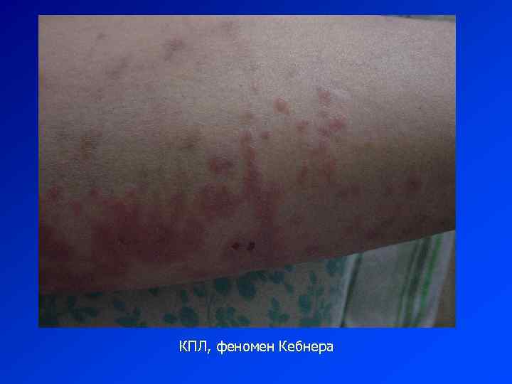 КПЛ, феномен Кебнера 