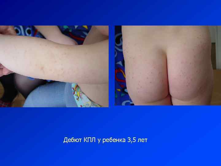Дебют КПЛ у ребенка 3, 5 лет 