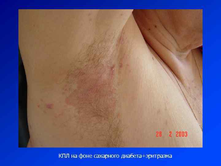 КПЛ на фоне сахарного диабета+эритразма 