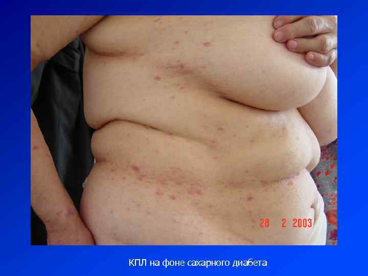 КПЛ на фоне сахарного диабета 