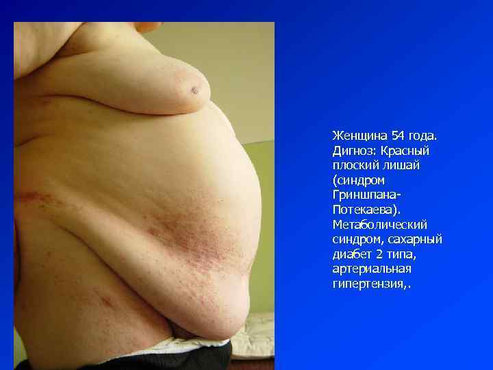 Женщина 54 года. Дигноз: Красный плоский лишай (синдром Гриншпана. Потекаева). Метаболический синдром, сахарный диабет