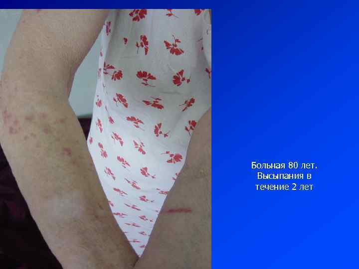 Больная 80 лет. Высыпания в течение 2 лет 