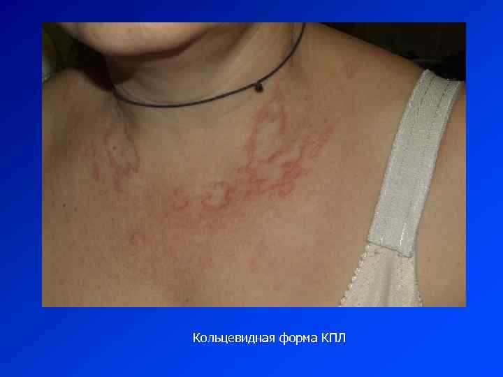 Кольцевидная форма КПЛ 