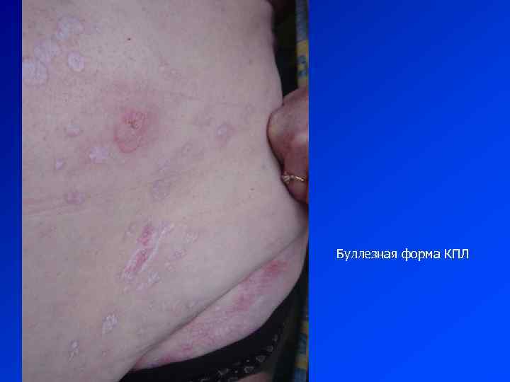 Буллезная форма КПЛ 
