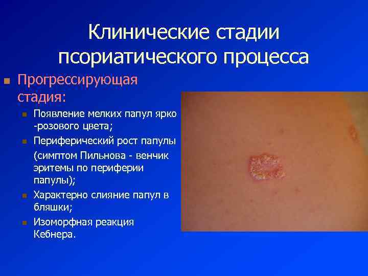 Клинические стадии псориатического процесса n Прогрессирующая стадия: n n Появление мелких папул ярко -розового