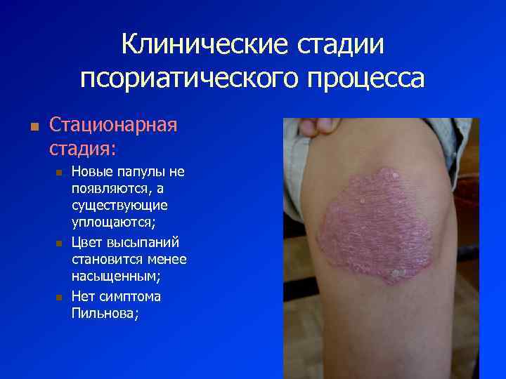 Клинические стадии псориатического процесса n Стационарная стадия: n n n Новые папулы не появляются,