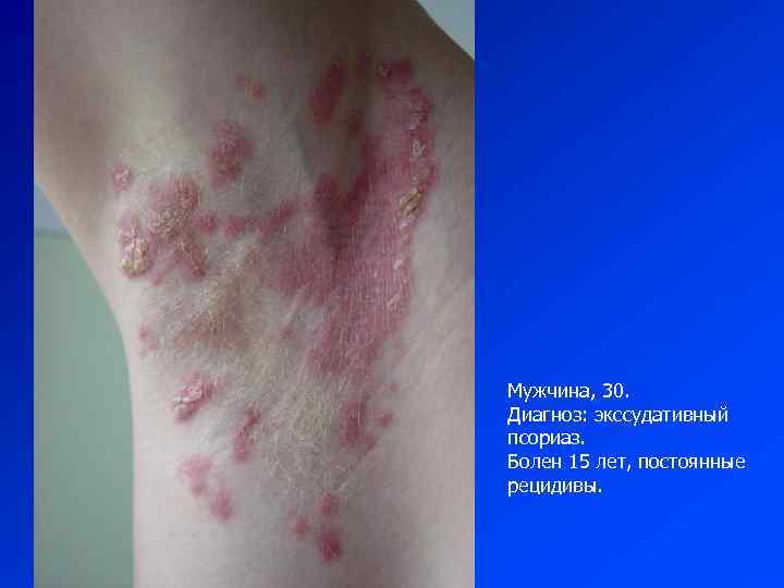 Мужчина, 30. Диагноз: экссудативный псориаз. Болен 15 лет, постоянные рецидивы. 