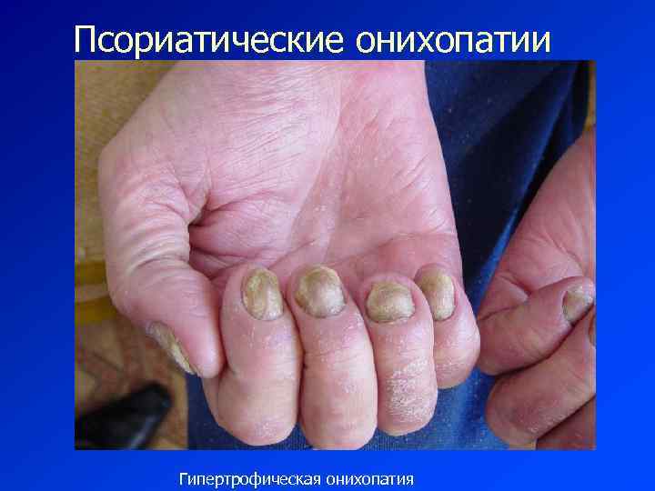 Псориатические онихопатии Гипертрофическая онихопатия 