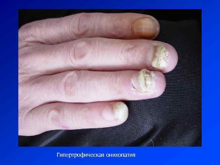 Гипертрофическая онихопатия 
