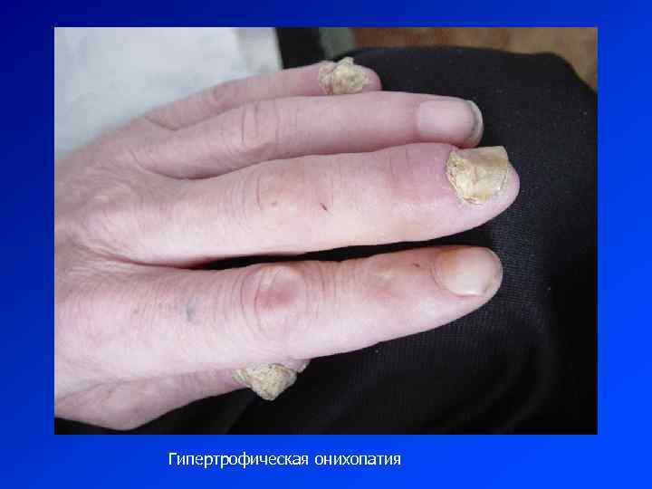Гипертрофическая онихопатия 