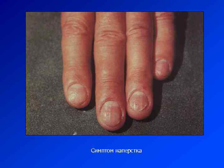 Симптом наперстка 